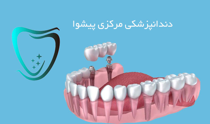 متخصص ایمپلنت محدوده ورامین